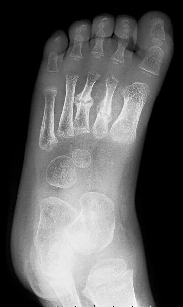 Broken foot, X-ray C017  /  7975