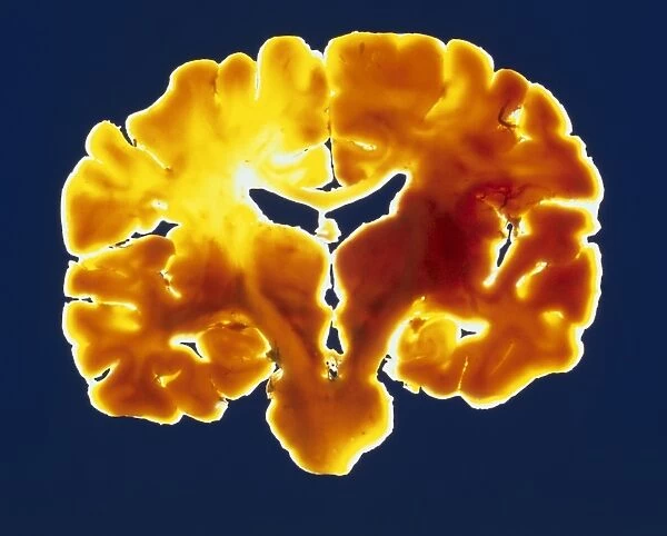 Coronal slice through a healthy human brain