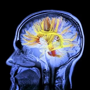 Brain MRI scan with Alzheimers QR code
