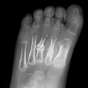 Broken foot, X-ray C017 / 7975