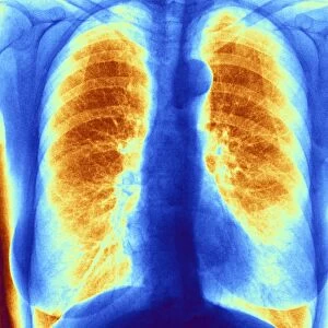 Normal chest, coloured x-ray C013 / 5283