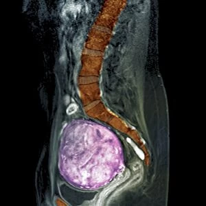 Uterine fibroids, MRI scan C018 / 0469