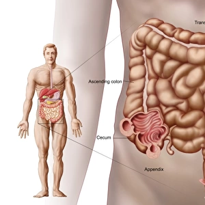 Diverticulitis in the descending colon region of the human intestine