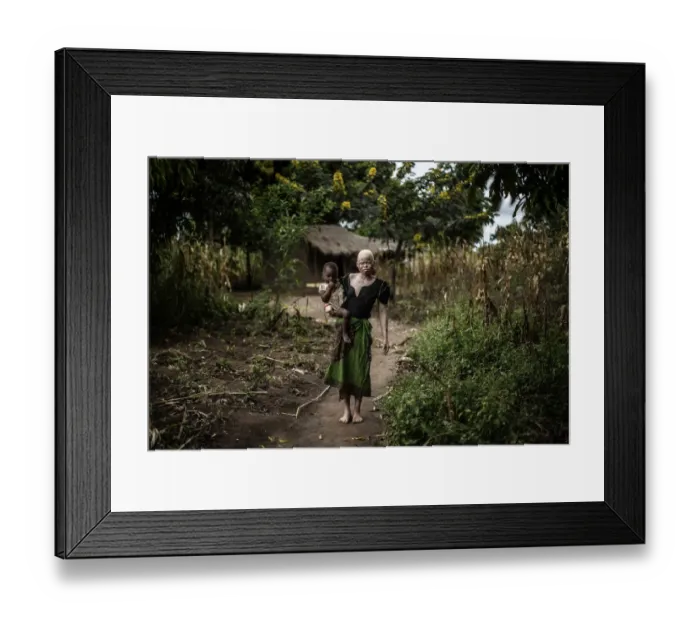 Framed Print : Malawi-Albinos-Feature Framed Print : Malawi-Albinos-Feature