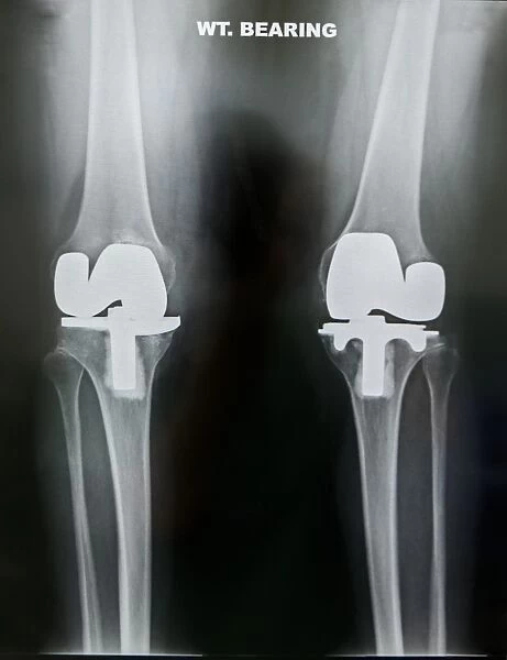Artificial knee joints in obesity, X-ray