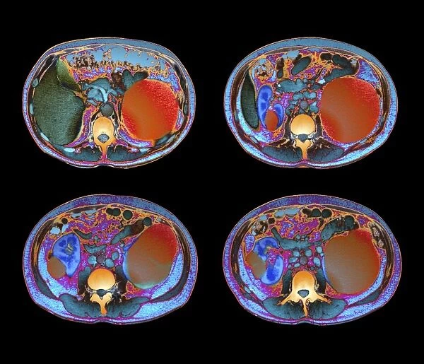 Polycystic kidneys, CT scans C018  /  0572