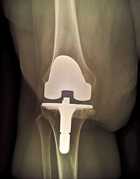 Prosthetic knee and obesity, X-ray C016  /  6594