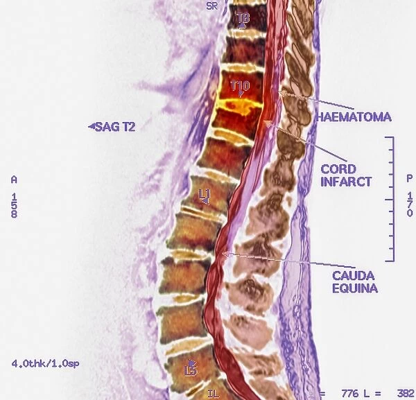 Spinal cord stroke, MRI scan