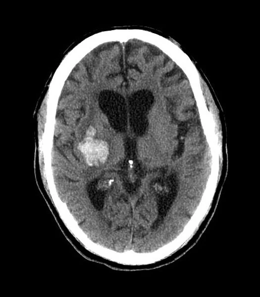 Subarachnoid haemorrhage, MRI scan