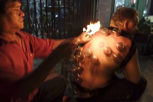 Fire cupping performed on a tourist