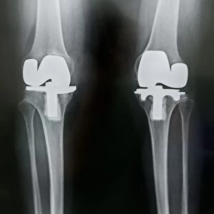 Artificial knee joints in obesity, X-ray