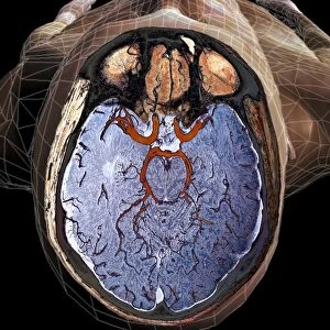 Brain blood supply, MRI scan C018 / 0432