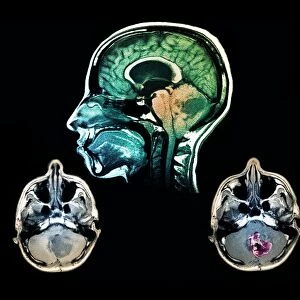 Brain tumour, MRI scans