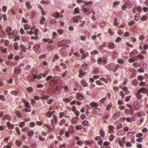 Langerhans cell histiocytosis C015 / 7135