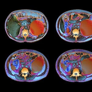 Polycystic kidneys, CT scans C018 / 0572