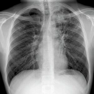 Tuberculosis, X-ray