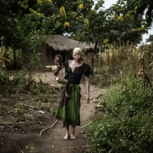 Malawi-Albinos-Feature
