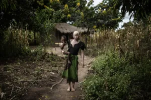 Malawi-Albinos-Feature Malawi-Albinos-Feature